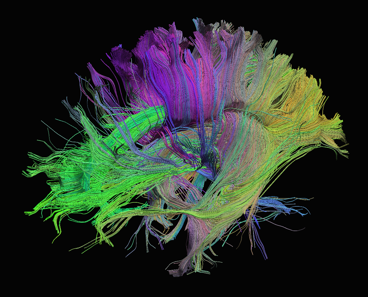 Фьюжн брейн. Трактография DTI. Коннектом. Коннектом растения. Трактография заболевание.