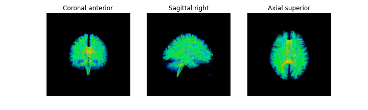 FA Mapped Tractography