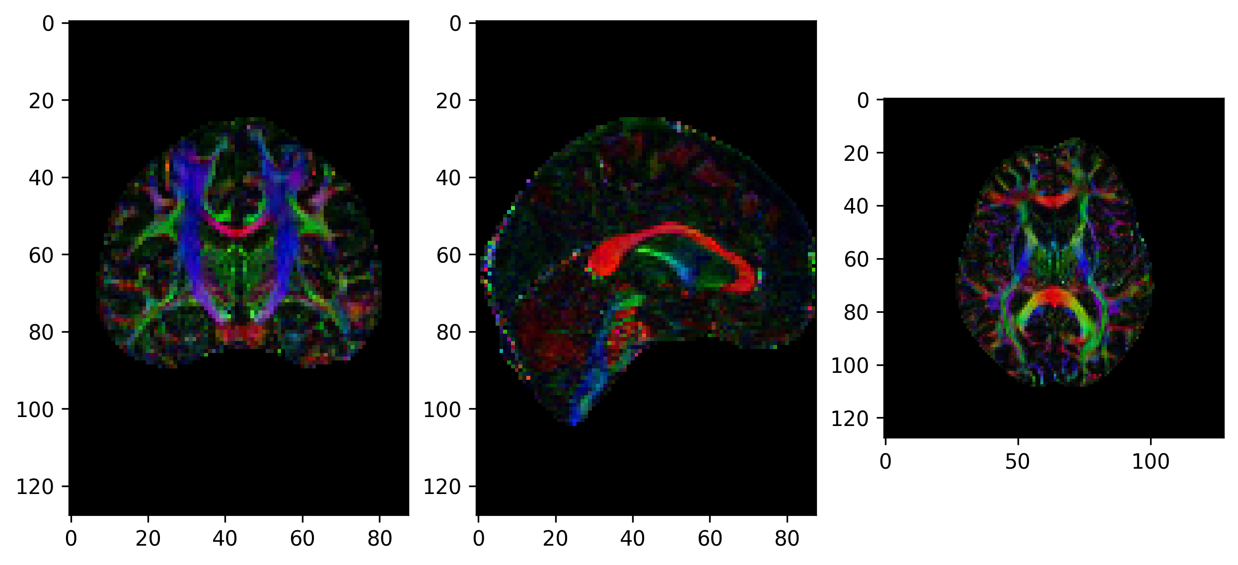 Introduction to dMRI: Diffusion Tensor Imaging (DTI)