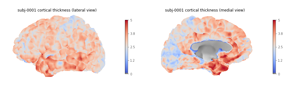 Cortical thickness visualization for a given subject