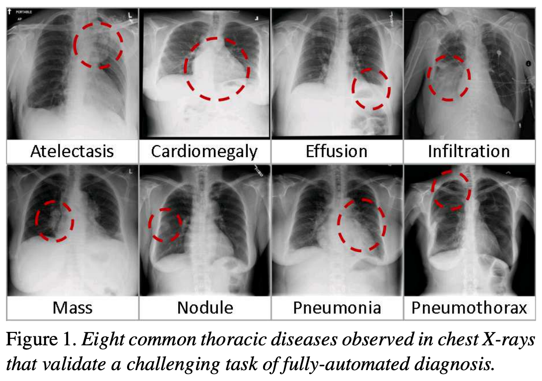 Chest X-ray diseases