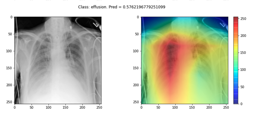 Saliency map for chest X-ray model
