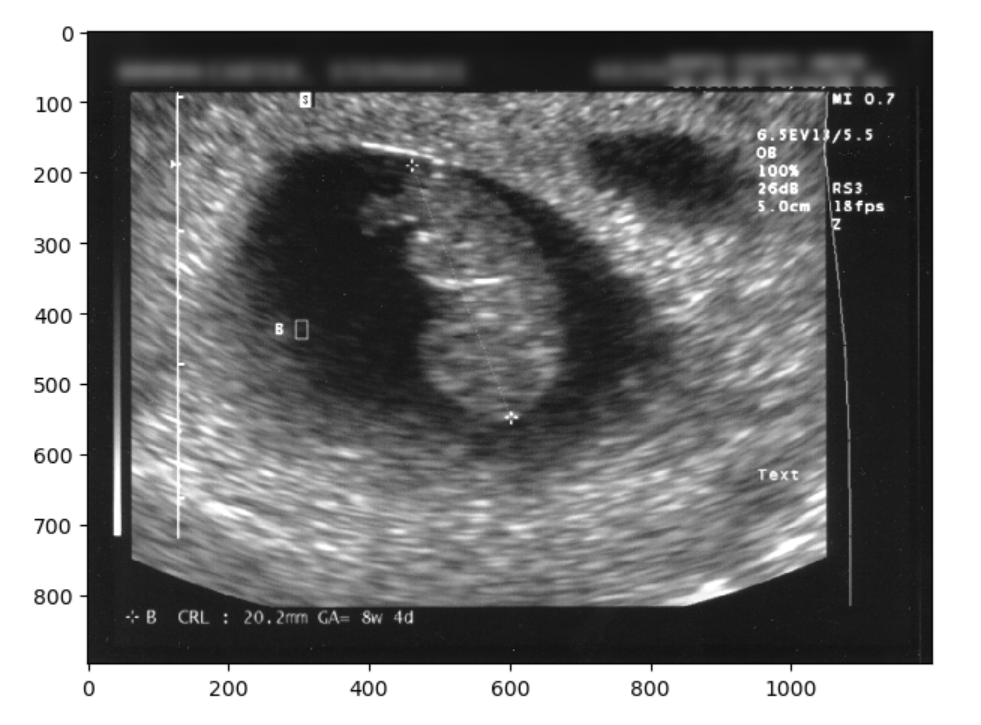 Non-Identifiable blurred ultrasound