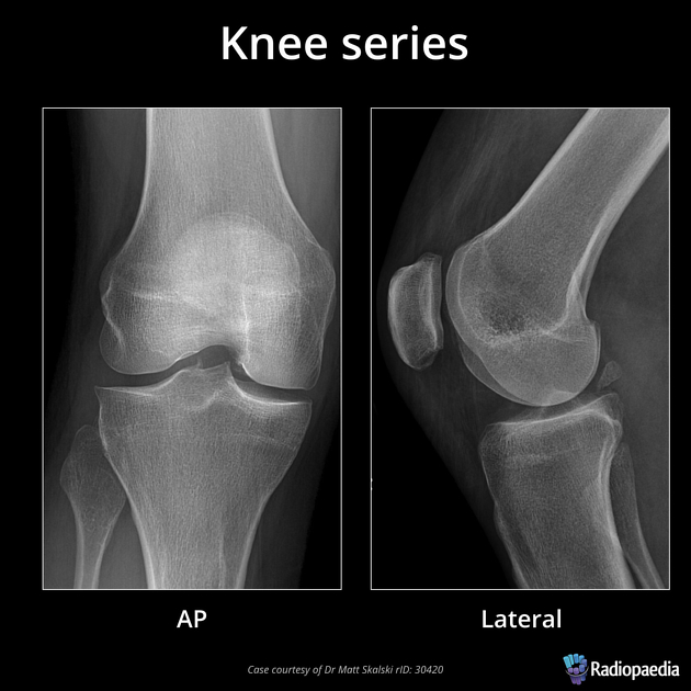 Knee series.