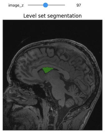 Level-set segmentation.