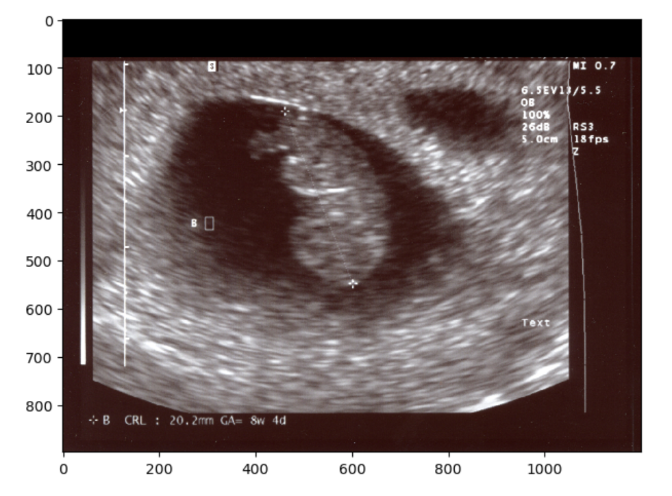 Non-Identifiable masked ultrasound