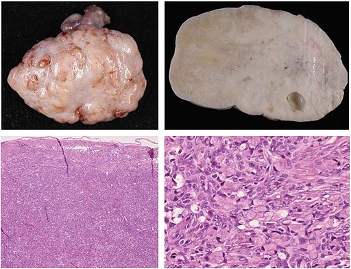 Gross and histopathology