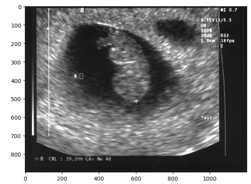 Non-Identifiable cropped ultrasound