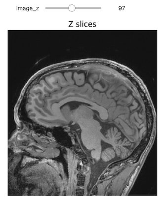 T1 MRI scan, Z slices.